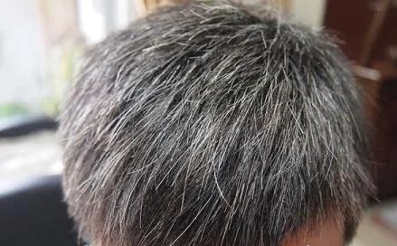 白发为什么越来越多，如何去养发