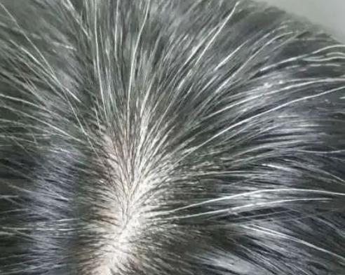 多少岁有白发不算早